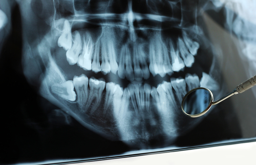Gum Disease Treatment North York